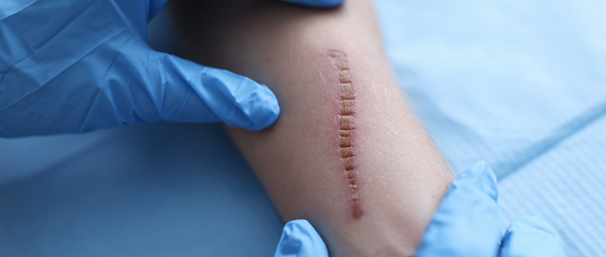 Kurs mobilizacji blizny po operacji – poszerzenie usług fizjoterapii i masażu